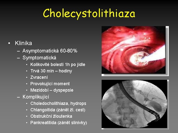 Cholecystolithiaza • Klinika – Asymptomatická 60 -80% – Symptomatická • • • Kolikovité bolesti