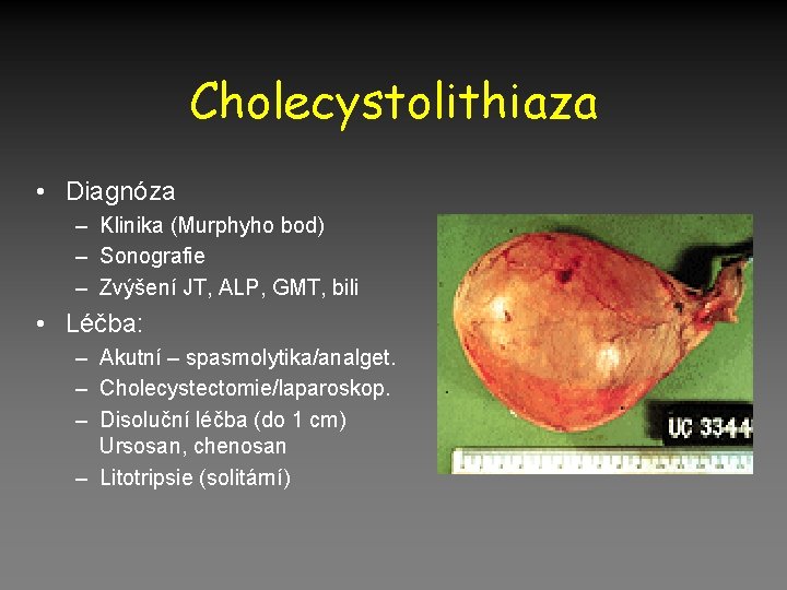 Cholecystolithiaza • Diagnóza – Klinika (Murphyho bod) – Sonografie – Zvýšení JT, ALP, GMT,