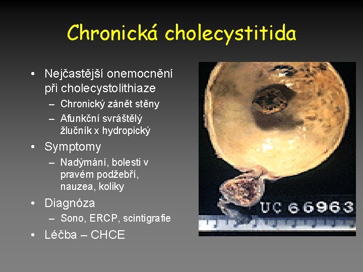 Chronická cholecystitida • Nejčastější onemocnění při cholecystolithiaze – Chronický zánět stěny – Afunkční svráštělý