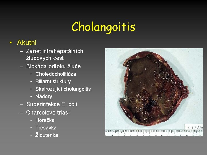 Cholangoitis • Akutní – Zánět intrahepatálních žlučových cest – Blokáda odtoku žluče • •