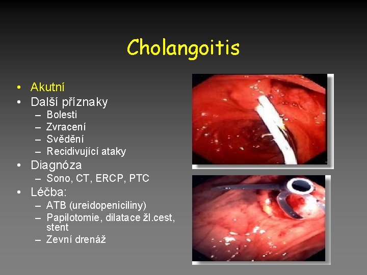 Cholangoitis • Akutní • Další příznaky – – Bolesti Zvracení Svědění Recidivující ataky •