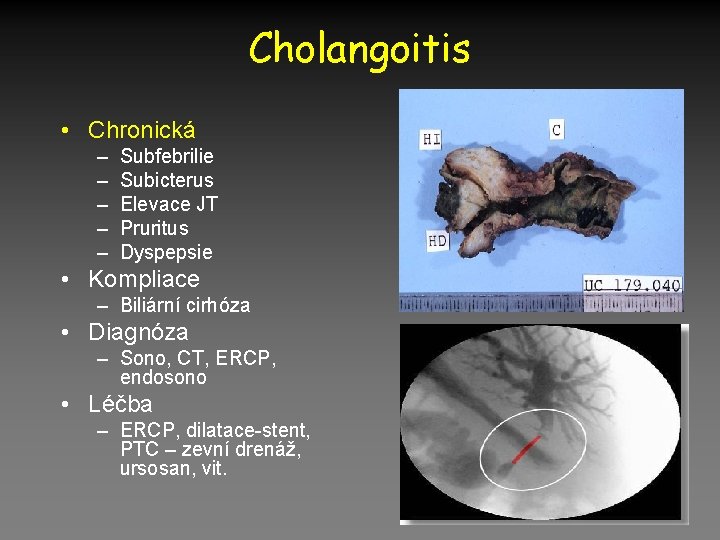 Cholangoitis • Chronická – – – Subfebrilie Subicterus Elevace JT Pruritus Dyspepsie • Kompliace