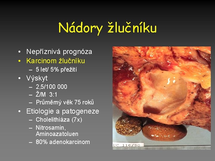 Nádory žlučníku • Nepříznivá prognóza • Karcinom žlučníku – 5 let/ 5% přežití •