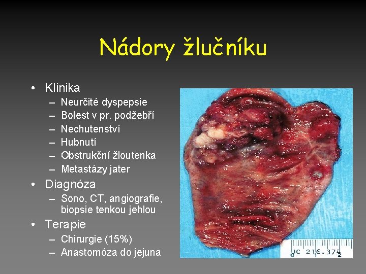 Nádory žlučníku • Klinika – – – Neurčité dyspepsie Bolest v pr. podžebří Nechutenství