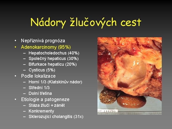 Nádory žlučových cest • Nepříznivá prognóza • Adenokarcinomy (95%) – – Hepatocholedochus (40%) Společný