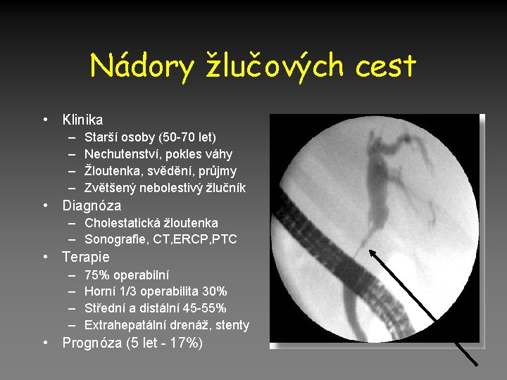 Nádory žlučových cest • Klinika – – Starší osoby (50 -70 let) Nechutenství, pokles