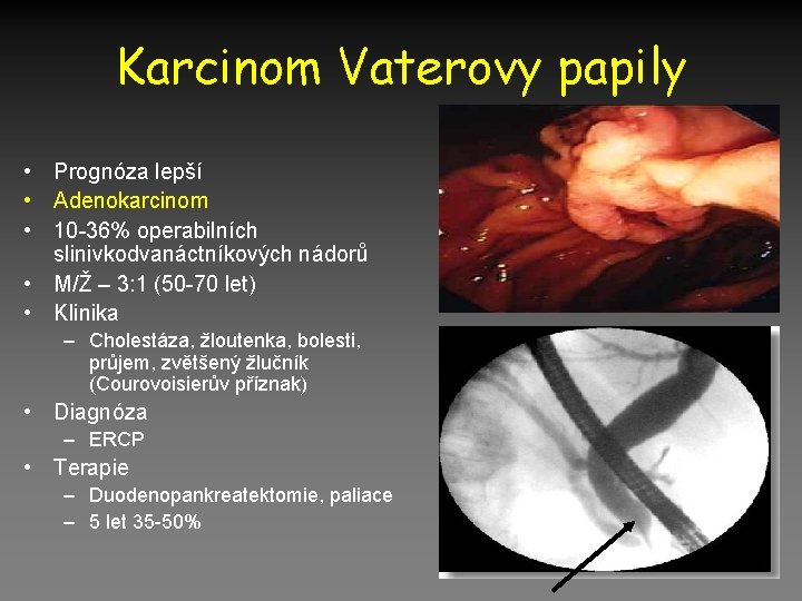 Karcinom Vaterovy papily • Prognóza lepší • Adenokarcinom • 10 -36% operabilních slinivkodvanáctníkových nádorů