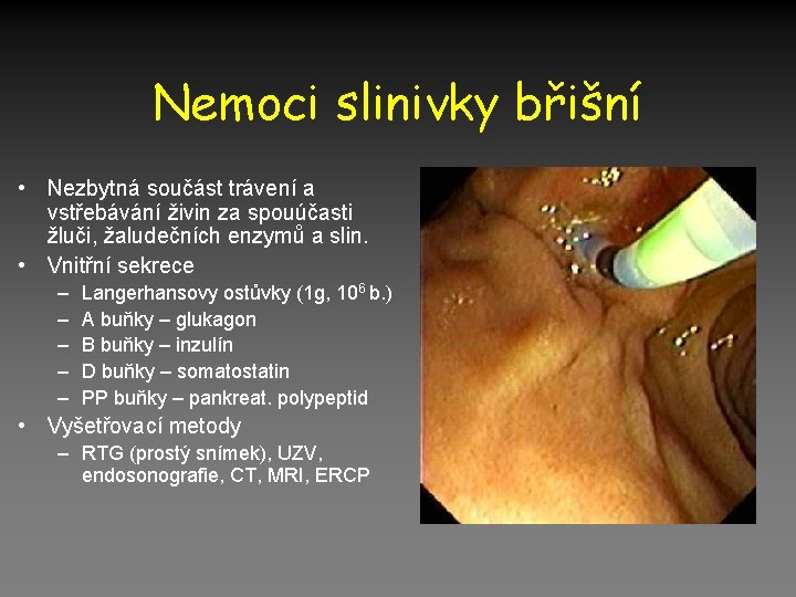 Nemoci slinivky břišní • Nezbytná součást trávení a vstřebávání živin za spouúčasti žluči, žaludečních