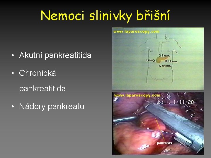 Nemoci slinivky břišní • Akutní pankreatitida • Chronická pankreatitida • Nádory pankreatu 