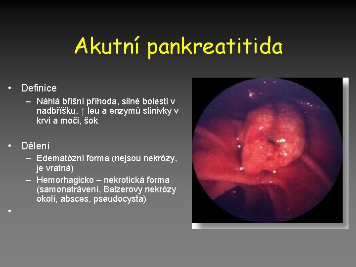 Akutní pankreatitida • Definice – Náhlá břišní příhoda, silné bolesti v nadbříšku, ↑ leu