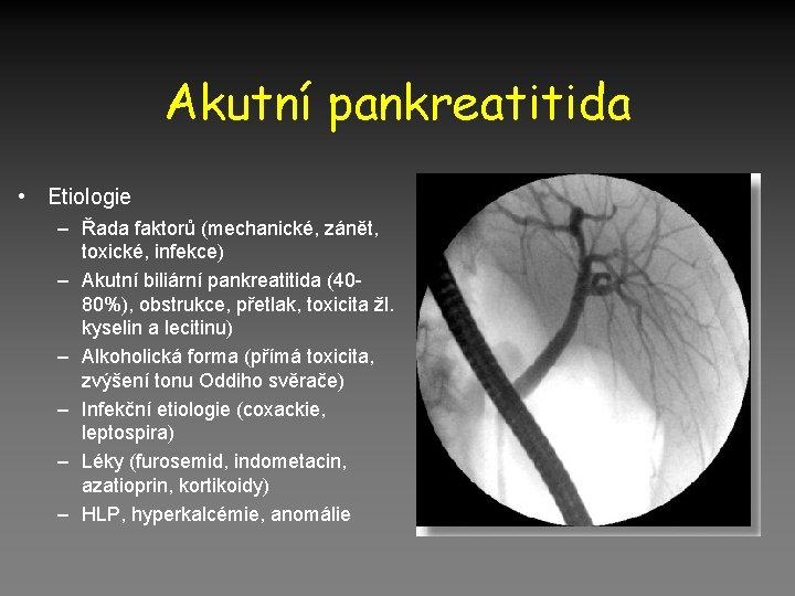 Akutní pankreatitida • Etiologie – Řada faktorů (mechanické, zánět, toxické, infekce) – Akutní biliární