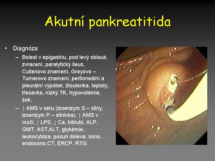 Akutní pankreatitida • Diagnóza – Bolest v epigastriu, pod levý oblouk, zvracení, paralytický ileus,