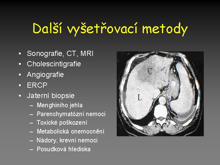 Další vyšetřovací metody • • • Sonografie, CT, MRI Cholescintigrafie Angiografie ERCP Jaterní biopsie