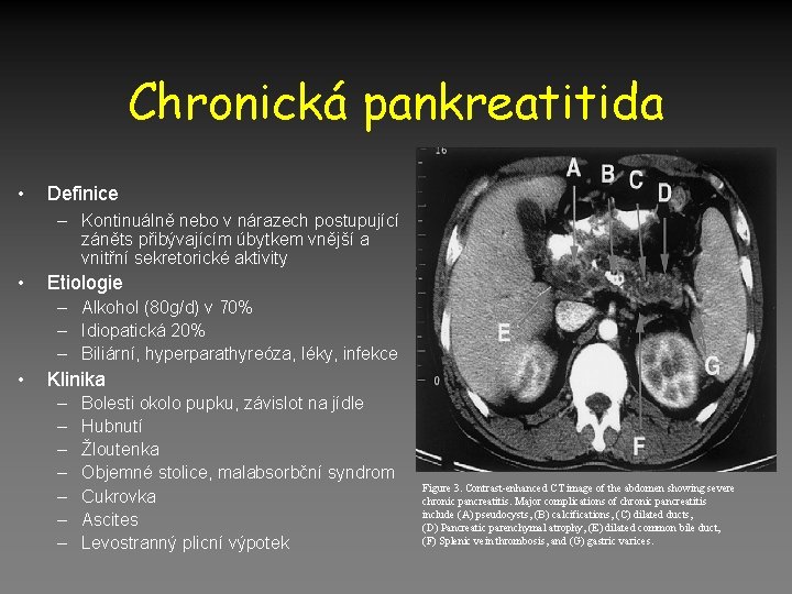 Chronická pankreatitida • Definice – Kontinuálně nebo v nárazech postupující záněts přibývajícím úbytkem vnější