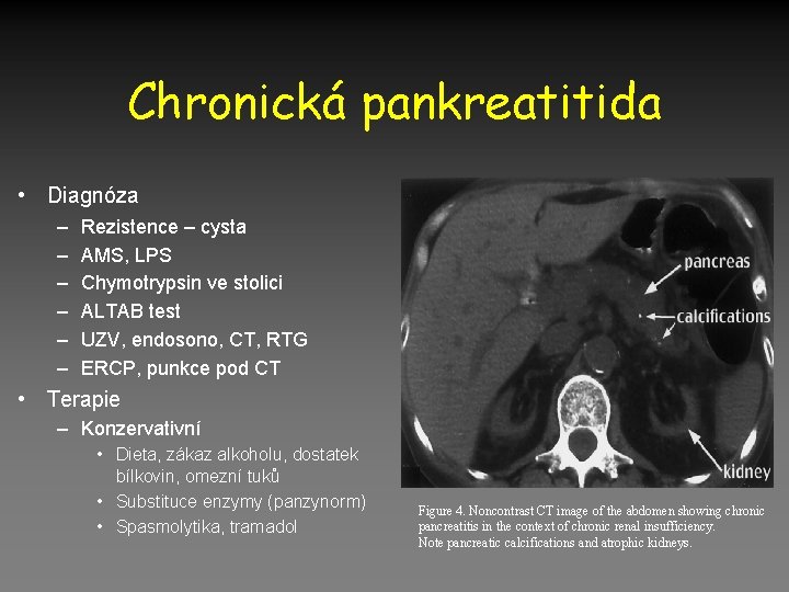 Chronická pankreatitida • Diagnóza – – – Rezistence – cysta AMS, LPS Chymotrypsin ve