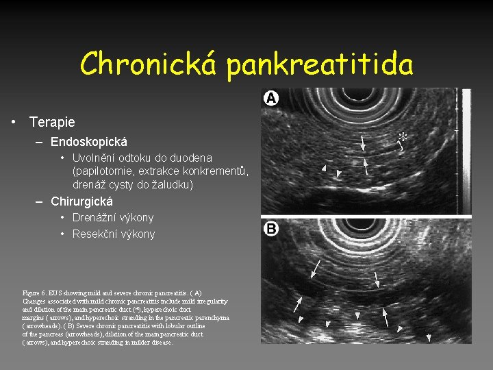 Chronická pankreatitida • Terapie – Endoskopická • Uvolnění odtoku do duodena (papilotomie, extrakce konkrementů,