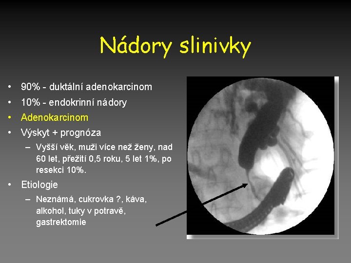 Nádory slinivky • 90% - duktální adenokarcinom • 10% - endokrinní nádory • Adenokarcinom