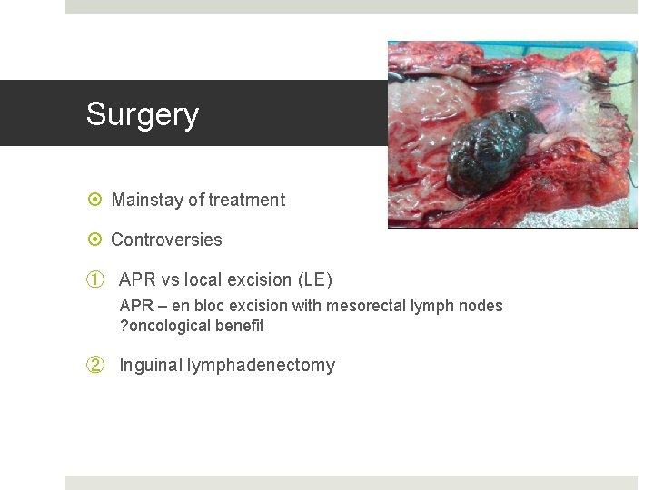 Surgery Mainstay of treatment Controversies ① APR vs local excision (LE) APR – en
