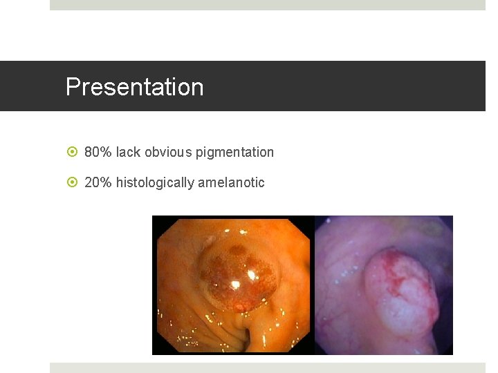 Presentation 80% lack obvious pigmentation 20% histologically amelanotic 