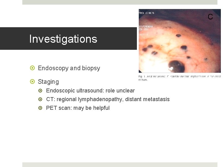 Investigations Endoscopy and biopsy Staging Endoscopic ultrasound: role unclear CT: regional lymphadenopathy, distant metastasis