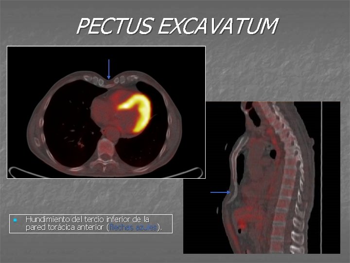 PECTUS EXCAVATUM n Hundimiento del tercio inferior de la pared torácica anterior (flechas azules).