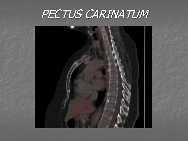 PECTUS CARINATUM 