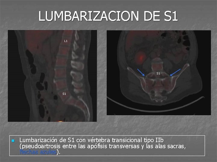 LUMBARIZACION DE S 1 L 1 S 1 n Lumbarización de S 1 con