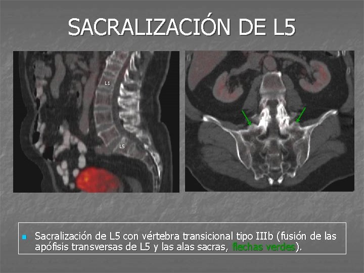 SACRALIZACIÓN DE L 5 L 1 L 5 n Sacralización de L 5 con