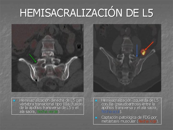 HEMISACRALIZACIÓN DE L 5 n Hemisacralización derecha de L 5 con vértebra transicional tipo