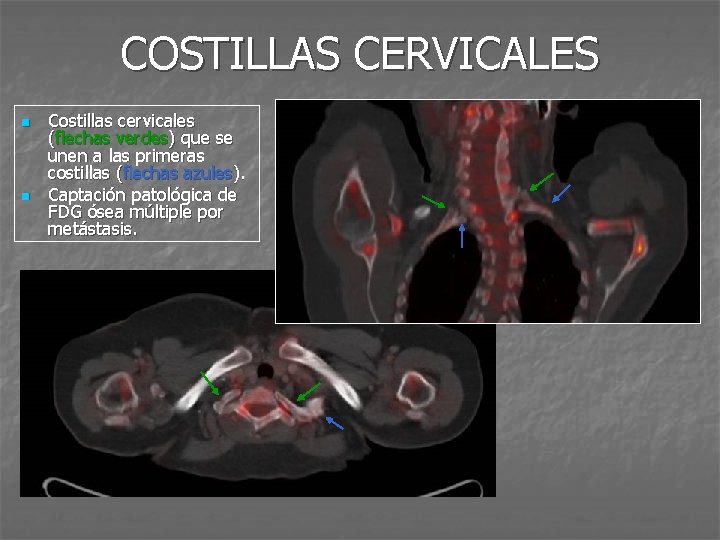COSTILLAS CERVICALES n n Costillas cervicales (flechas verdes) que se unen a las primeras