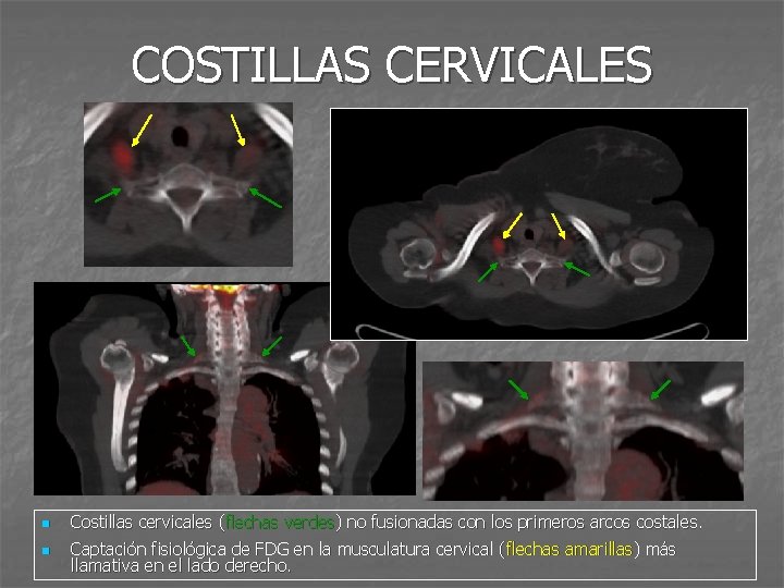 COSTILLAS CERVICALES n Costillas cervicales (flechas verdes) no fusionadas con los primeros arcos costales.