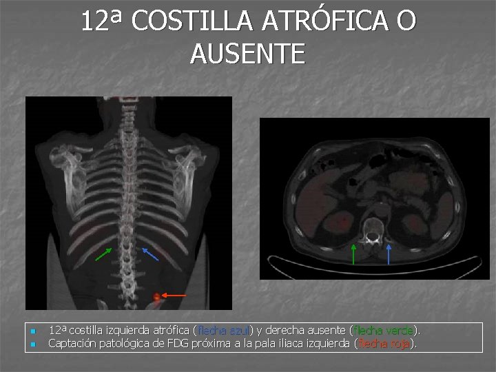 12ª COSTILLA ATRÓFICA O AUSENTE n n 12ª costilla izquierda atrófica (flecha azul) y