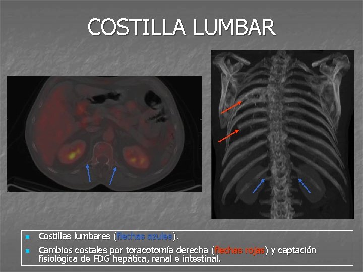 COSTILLA LUMBAR n Costillas lumbares (flechas azules). n Cambios costales por toracotomía derecha (flechas