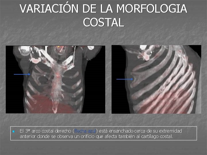 VARIACIÓN DE LA MORFOLOGIA COSTAL n El 3 er arco costal derecho (flecha azul)