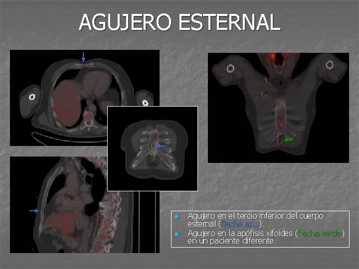 AGUJERO ESTERNAL n n Agujero en el tercio inferior del cuerpo esternal (flecha azul).