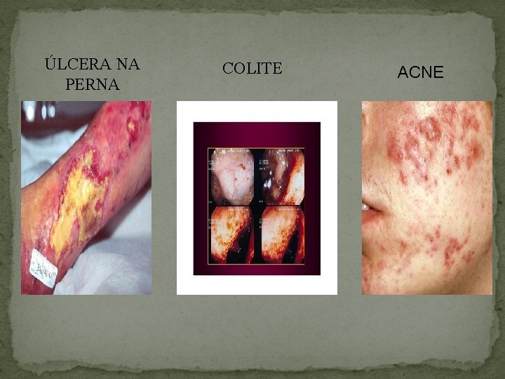 ÚLCERA NA PERNA COLITE ACNE 