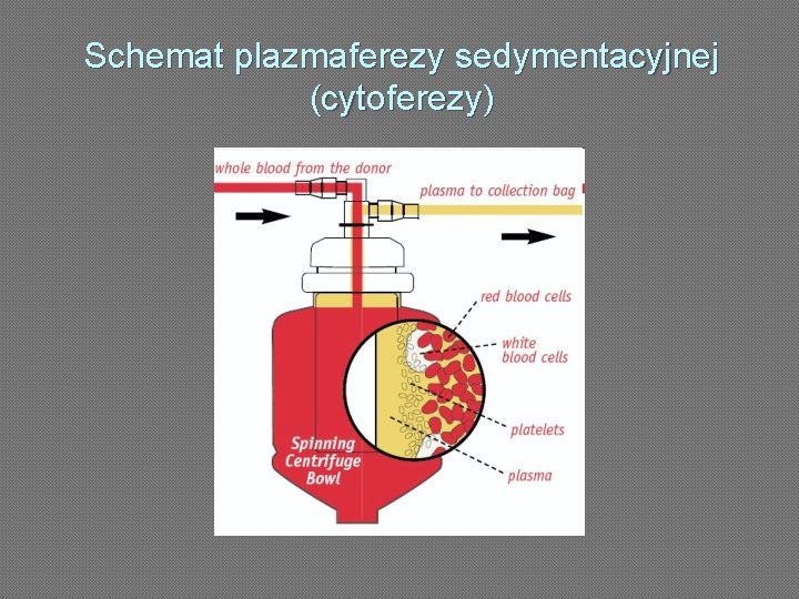 Schemat plazmaferezy sedymentacyjnej (cytoferezy) 