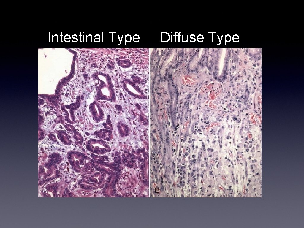 Intestinal Type Diffuse Type 
