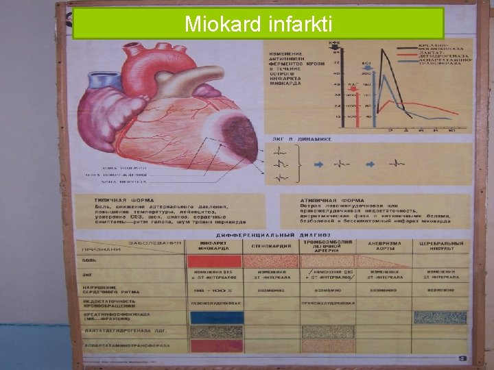 Miokard infarkti 