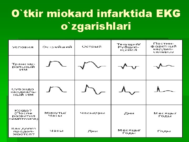 O`tkir miokard infarktida EKG o`zgarishlari 