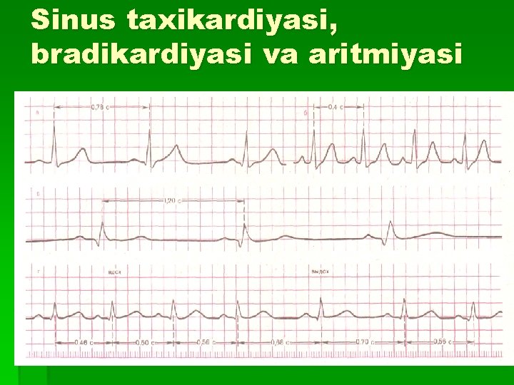 Sinus taxikardiyasi, bradikardiyasi va aritmiyasi 