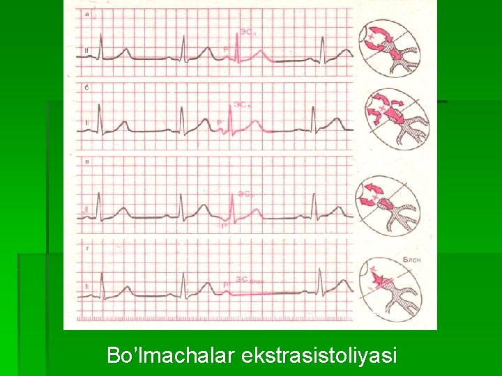 Bo’lmachalar ekstrasistoliyasi 