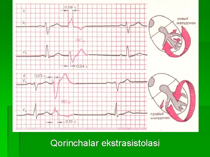 Qorinchalar ekstrasistolasi 
