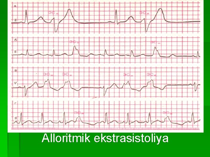 Аlloritmik ekstrasistoliya 