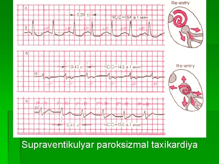 Supraventikulyar paroksizmal taxikardiya 