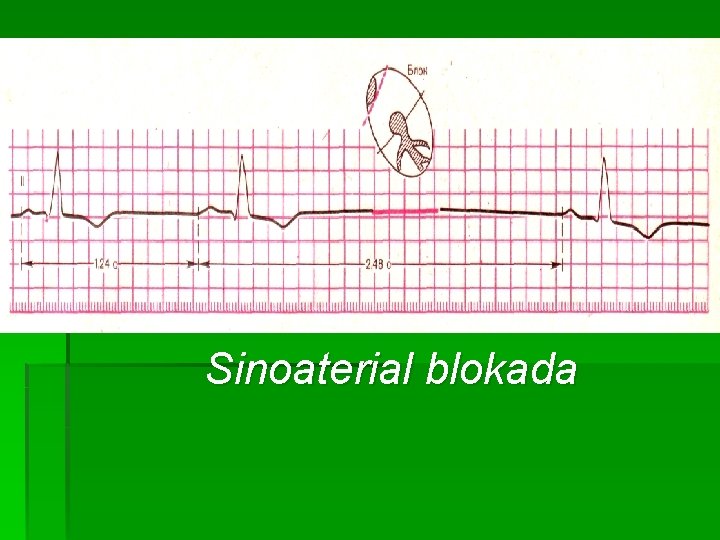 Sinoaterial blokada 