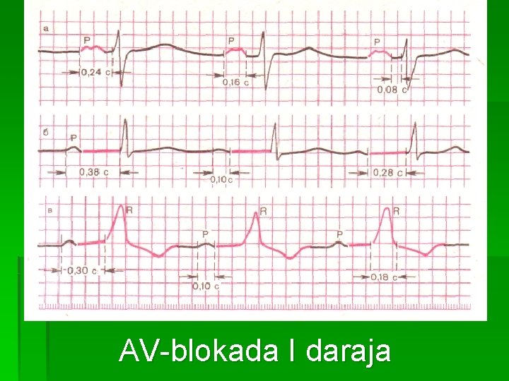 АV-blokada I daraja 