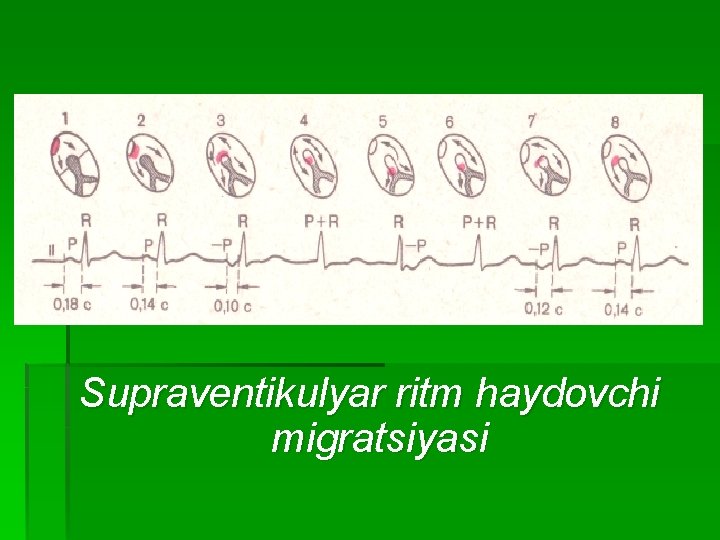 Supraventikulyar ritm haydovchi migratsiyasi 