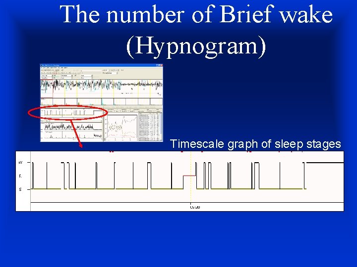 The number of Brief wake (Hypnogram) Timescale graph of sleep stages 