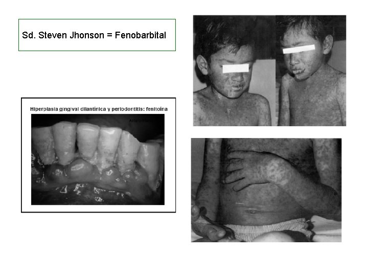 Sd. Steven Jhonson = Fenobarbital 